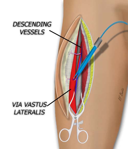 Dissection of the Posterior Flap