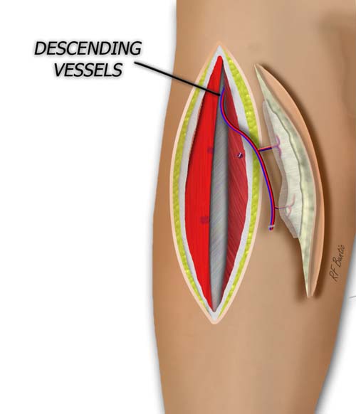 The Perforator and Pedicle are Dissected