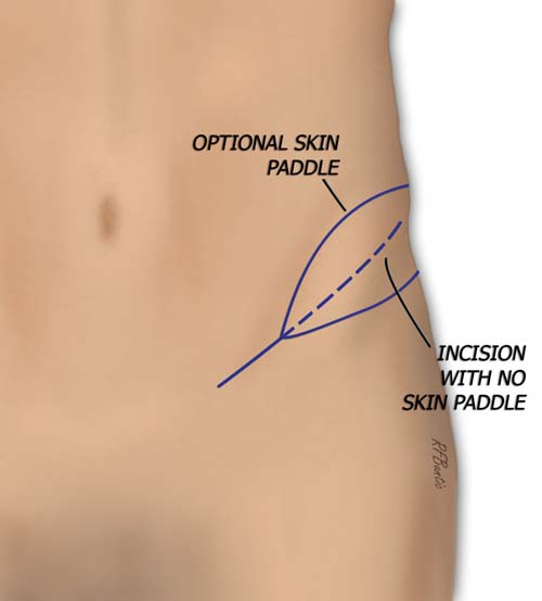 Marking the Incision