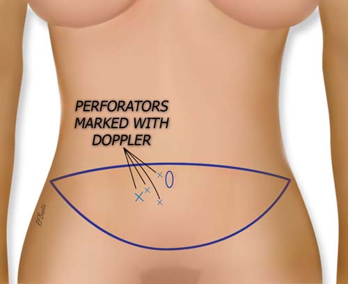 The Incision and Doppler Markings