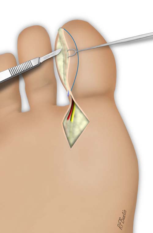 The Flap is Raised with the Pedicle