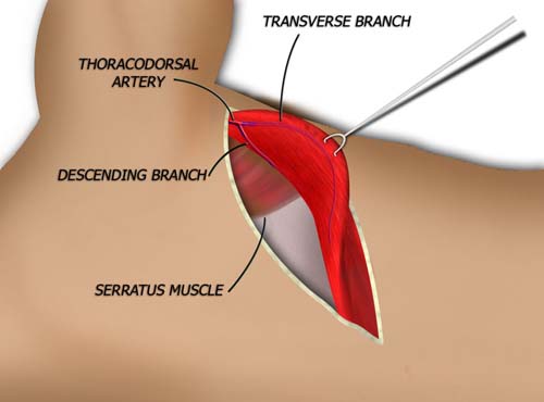 Elevation of the PSL Flap
