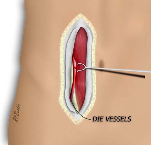 The Pedicle is Identified
