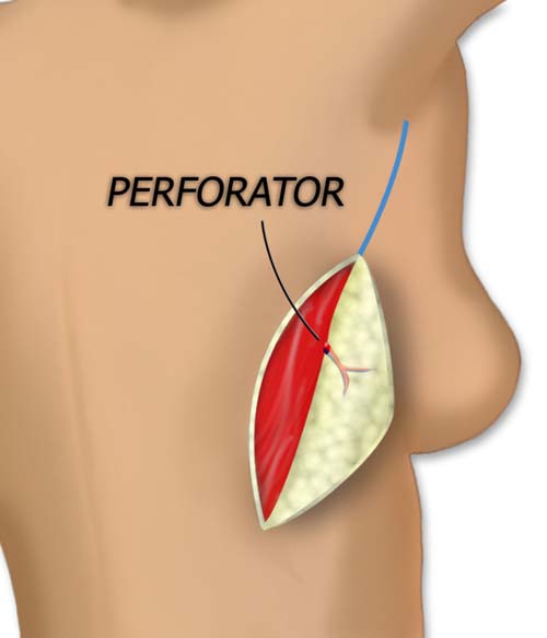 The Posterior Flap is Elevated