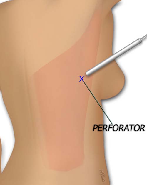 The Main Perforator is Identified