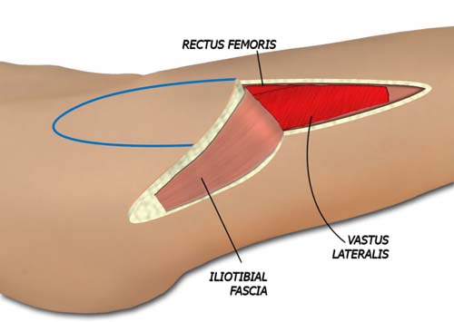 The Flap is Raised Distal to Proximal