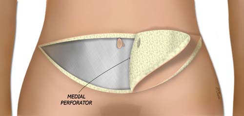 The Contralateral Flap is Elevated