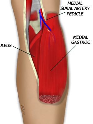gastrocnemius artery