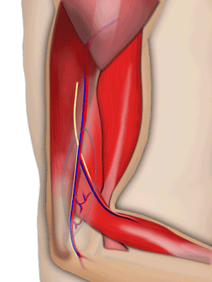 Lateral Arm flap